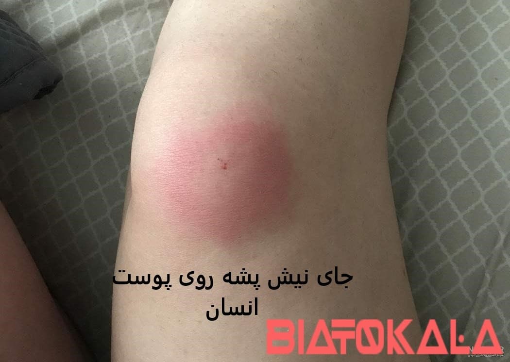 قرمزی جای نیش پشه